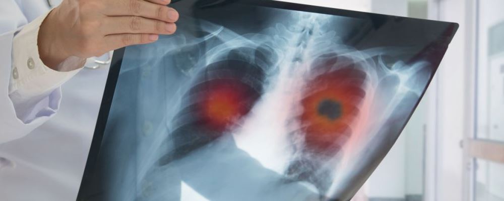 肺癌的六种常见征兆 哪些人群需特别警惕肺癌