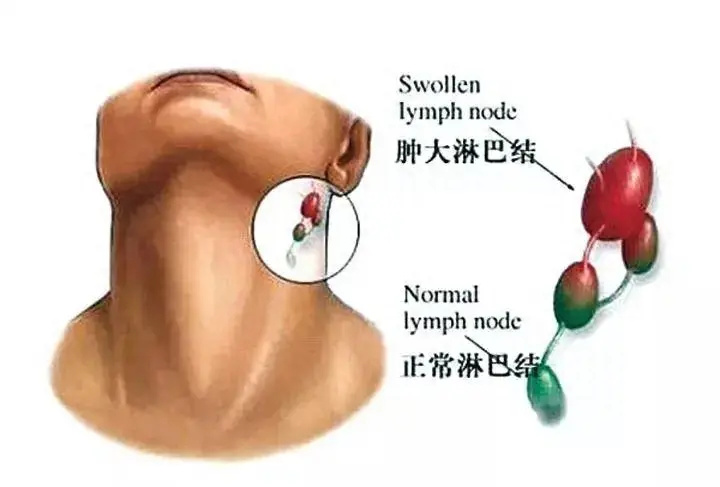 淋巴结肿大怎么办？（淋巴结肿大如何治疗）