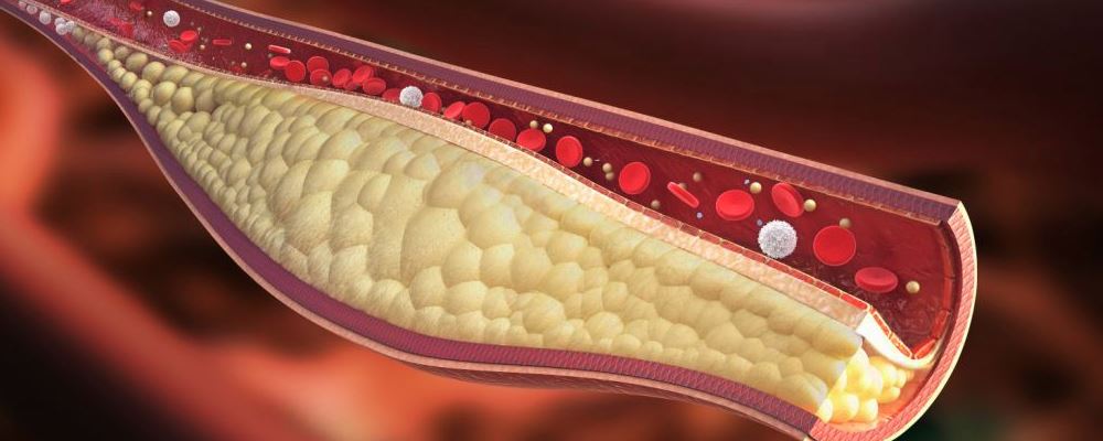 血管被堵是什么原因 血管堵塞的原因 如何保护血管