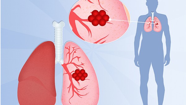 肺结核空洞2年还咯血是怎么回事？（肺结核空洞2年后还咯血是怎么回事）