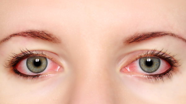 经常揉眼睛是怎么回事？（眼睛有慢性结膜炎，经常揉眼睛是怎么回事？）