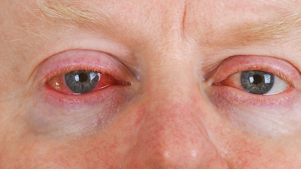 眼累红血丝结膜炎加干眼症