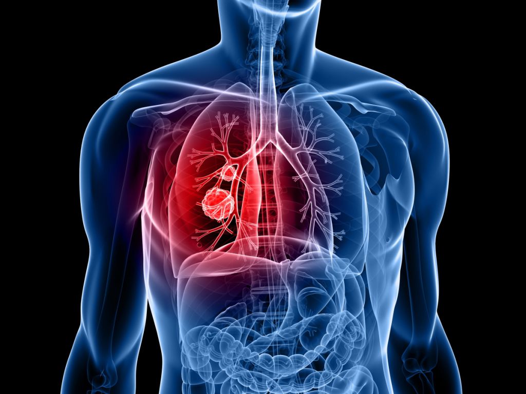 肺腺癌的饮食与保养 肺腺癌偏方土方秘方治疗